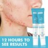 Mooyam Salicylic Acid Acne Gel
